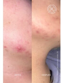 Bild von Acnemy Zitcontrol Treatment (40ml)