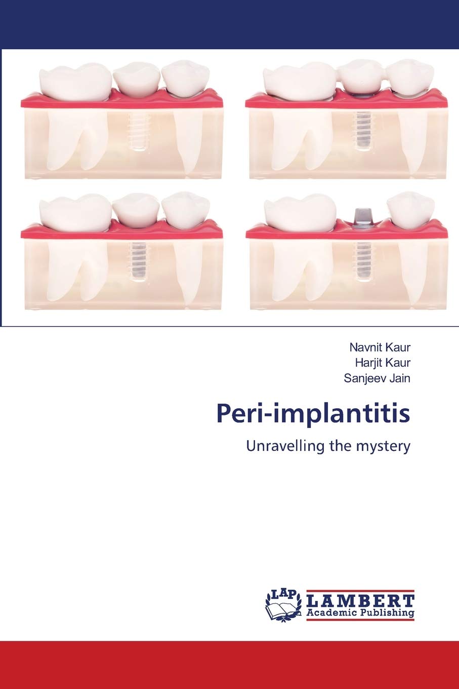 Bild von Peri-implantitis: Unravelling the mystery